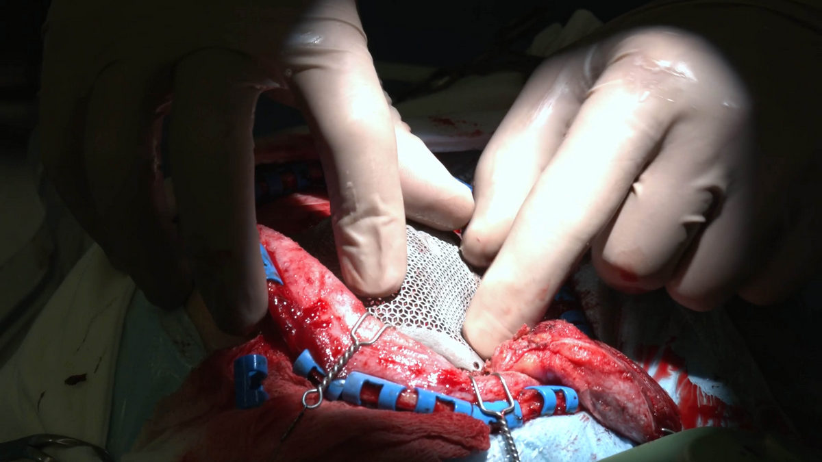 НМИЦ Мешалкина. Имплантация эндопротеза - соответствие удаленному участку полное.jpg НМИЦ Мешалкина. Имплантация эндопротеза - соответствие удаленному участку полное.jpg